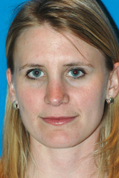 After Rhinoplasty