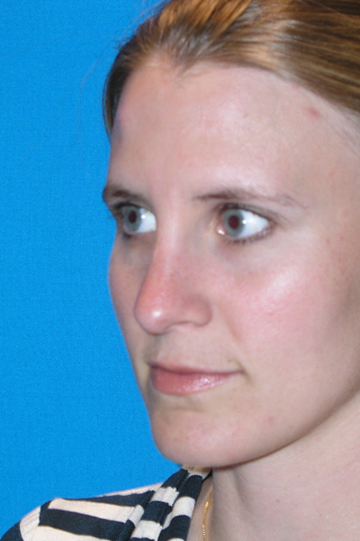 Before Rhinoplasty