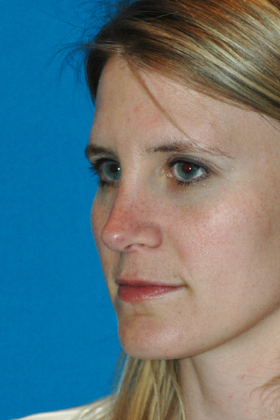 After Rhinoplasty