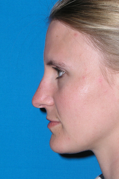 Before Rhinoplasty