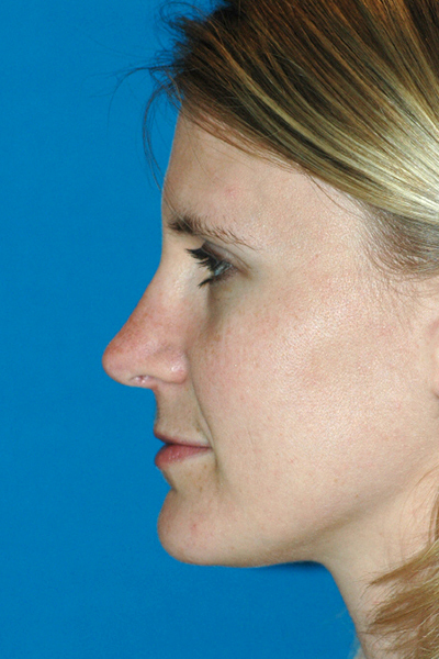 Rhinoplasty After