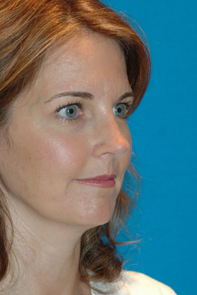 After Rhinoplasty