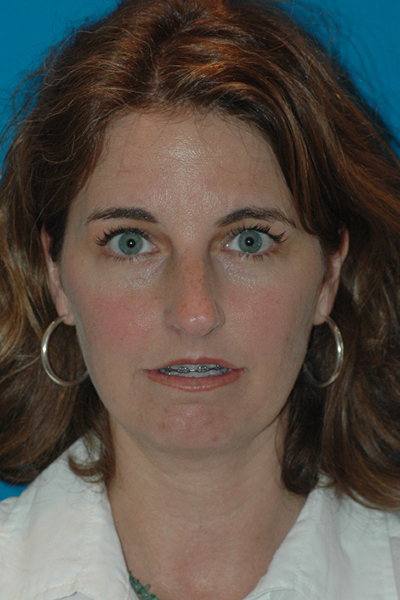 Before Rhinoplasty