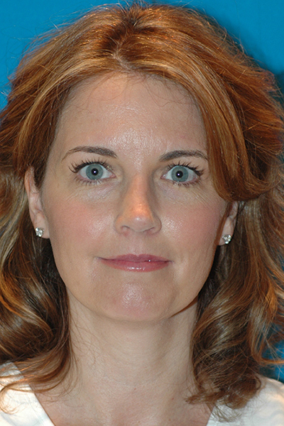 After Rhinoplasty
