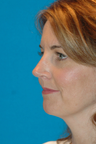 After Rhinoplasty