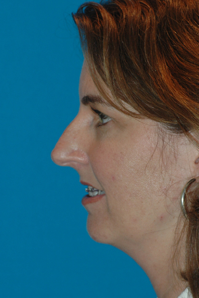 Before Rhinoplasty