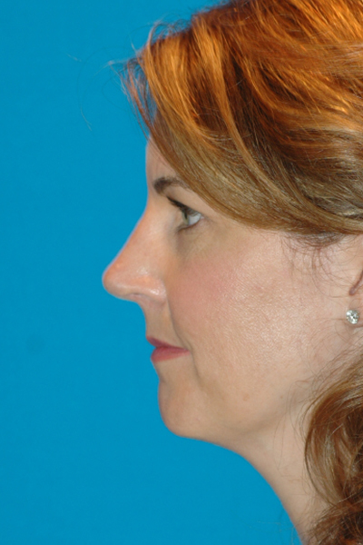 Rhinoplasty After