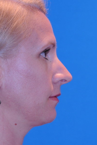 Rhinoplasty Before