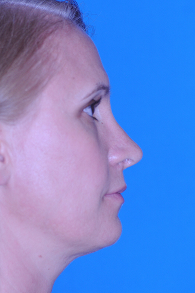 Rhinoplasty After