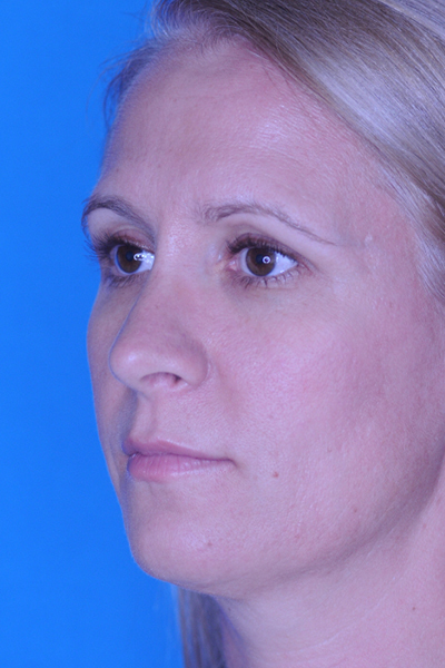 Rhinoplasty After