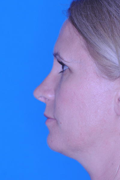 Rhinoplasty After