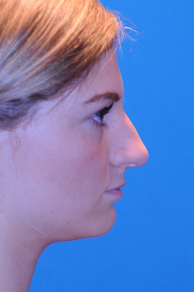 Rhinoplasty Before