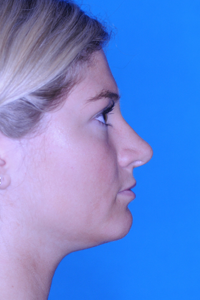 Rhinoplasty After