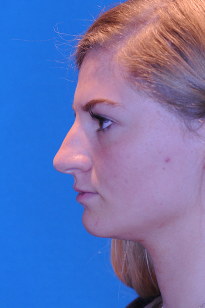 Rhinoplasty Before