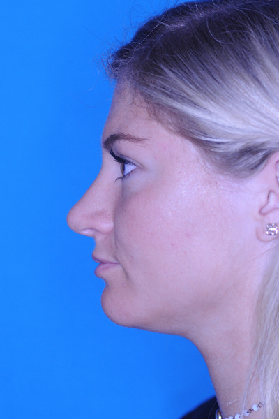 Rhinoplasty After