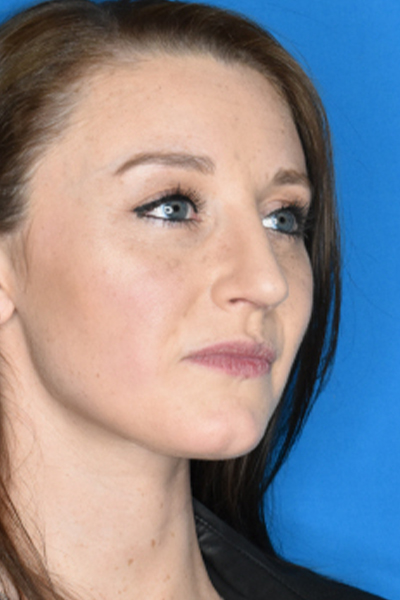 After Rhinoplasty