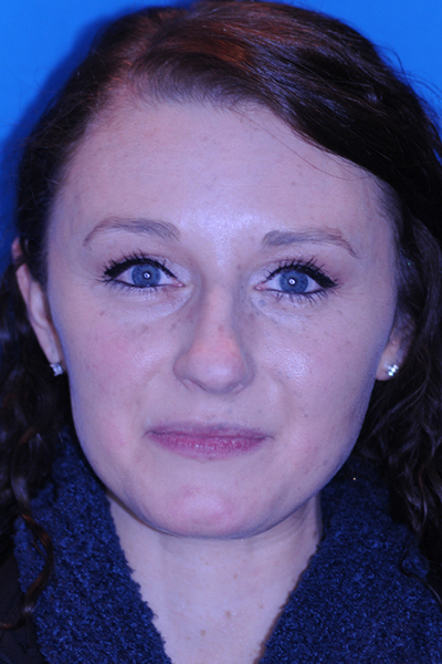 Before Rhinoplasty