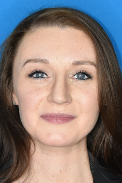 After Rhinoplasty