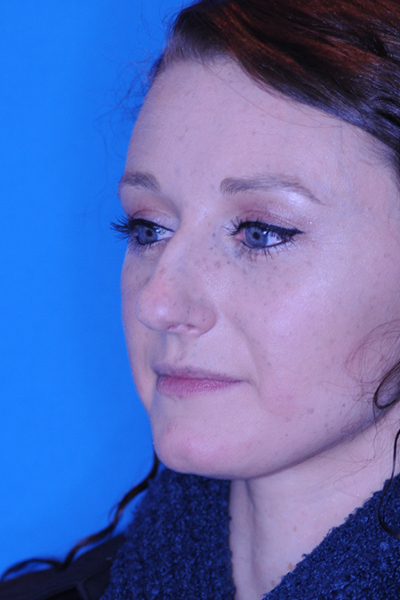 Before Rhinoplasty