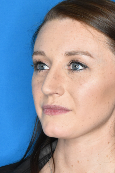 After Rhinoplasty