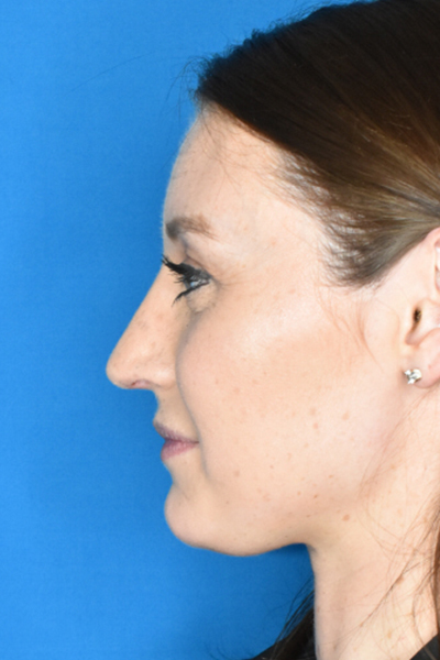 Rhinoplasty After