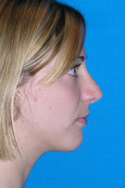 Rhinoplasty After