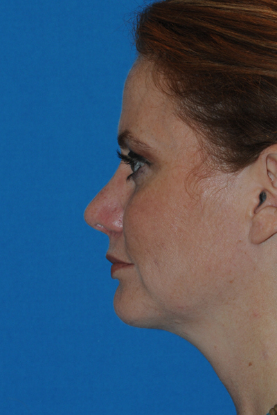 Rhinoplasty After